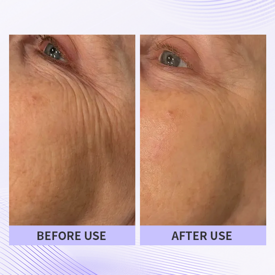🏆🏆Last day - Purchase TLUPA® anti-aging eye cream and enjoy a 60% discount. It is non-irritating when used and can be used throughout the day (quickly removes dark spots, reduces dark circles, and reduces eye bags)