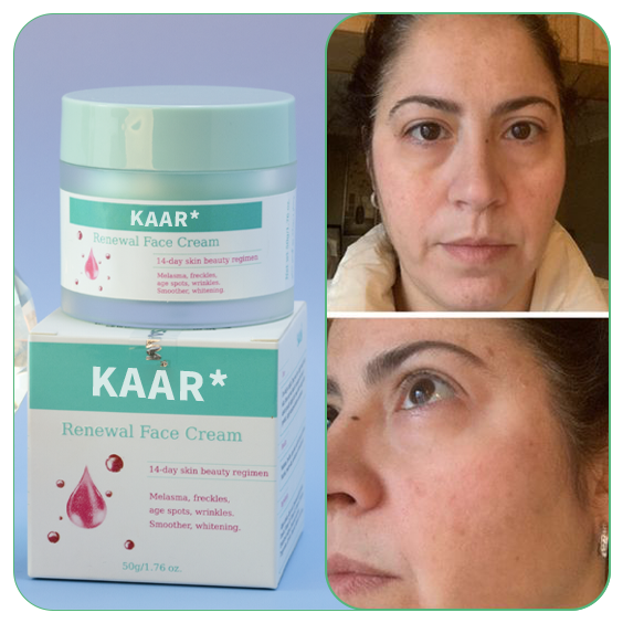 Final Hours—Sale Ending Soon!💥KAAR* Renewal Skin Cream | Spot Removal & Skin Renewal for Dark Spots, Age Spots, and Sun Spots* Daily Firming for All Skin Types