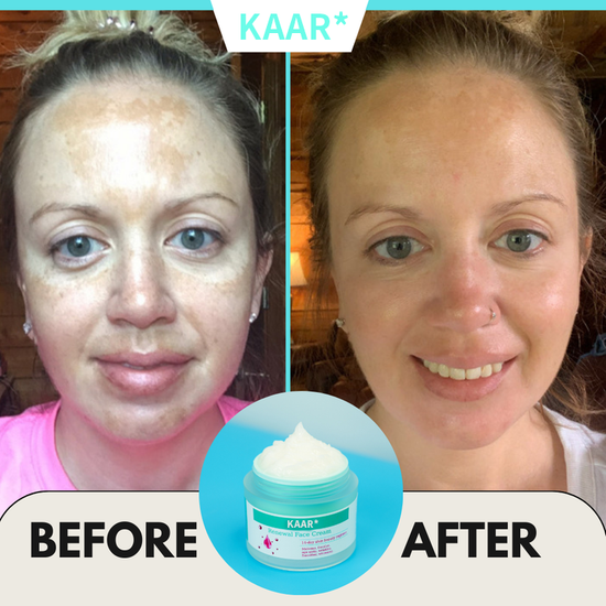 Final Hours—Sale Ending Soon!💥KAAR* Renewal Skin Cream | Spot Removal & Skin Renewal for Dark Spots, Age Spots, and Sun Spots* Daily Firming for All Skin Types