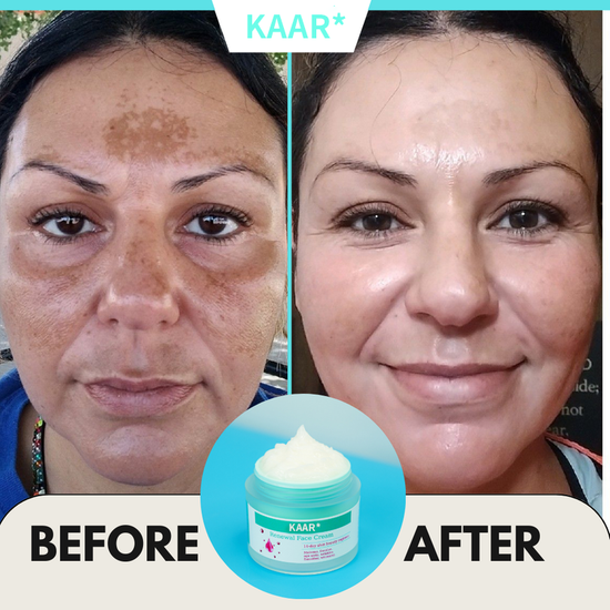 Final Hours—Sale Ending Soon!💥KAAR* Renewal Skin Cream | Spot Removal & Skin Renewal for Dark Spots, Age Spots, and Sun Spots* Daily Firming for All Skin Types