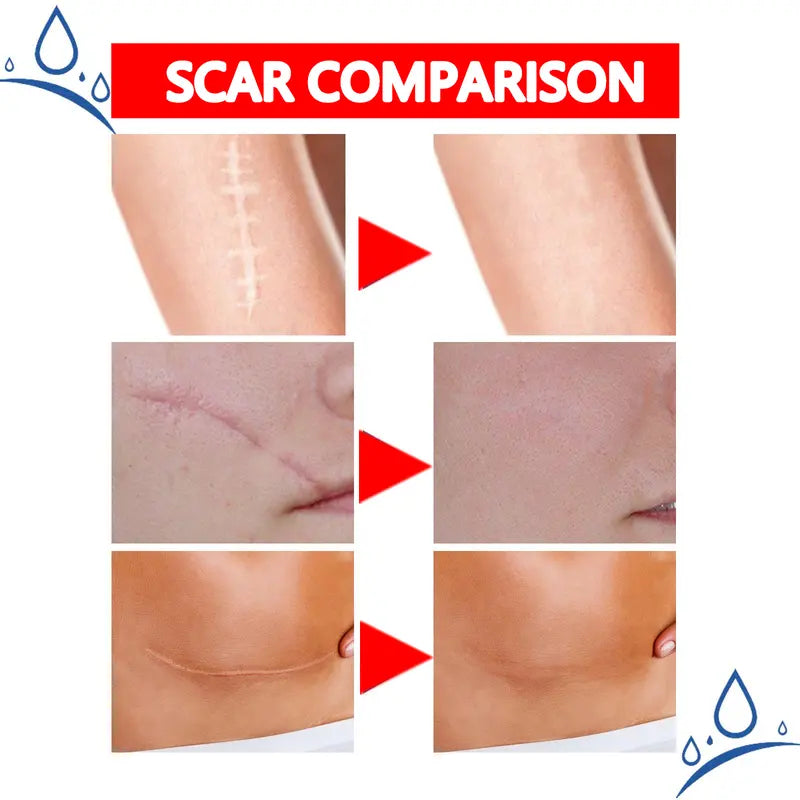 Final Hours—Sale Ending Soon!💥KAAR* Professional Scar Removal Gels | Gentle & Effective Daily Firming for All Skin Types